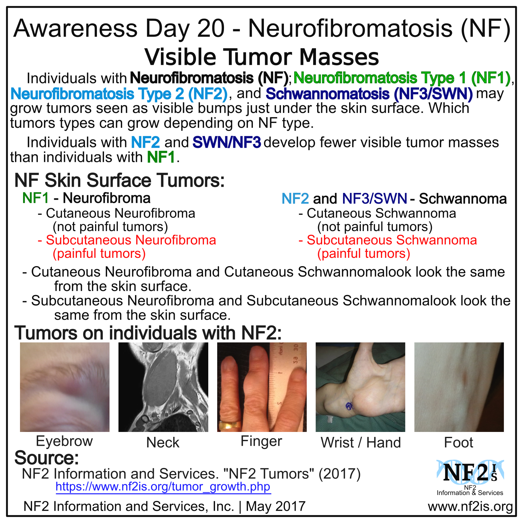 Nf Awareness Eyes Swn Skin Surface Tumors - Neurofibromatosis Types (1700x1700), Png Download