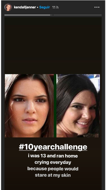 Kendall Jenner Se Une Al - Kendall Jenner Acne (650x642), Png Download