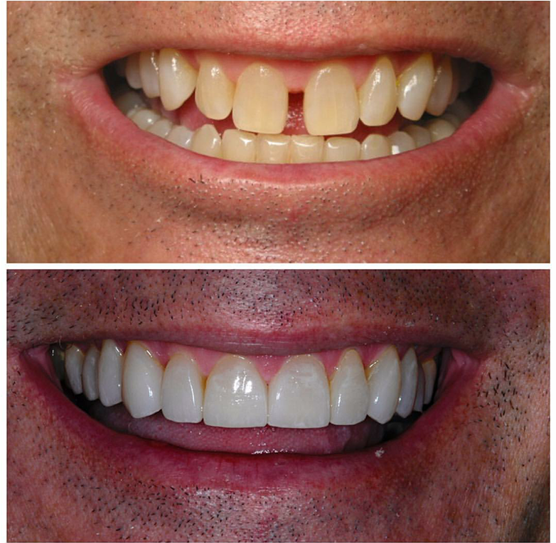 Closed-png - Cosmetic Dentistry (1024x764), Png Download