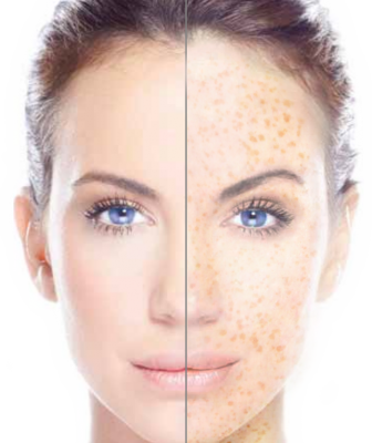 Face Hd Png Transparent Face Hd - Freckle Removal (336x400), Png Download