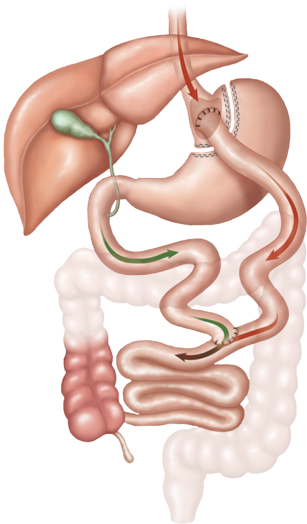 Gastric Bypass Surgery - Roux En Y Gastric Bypass (730x1127), Png Download