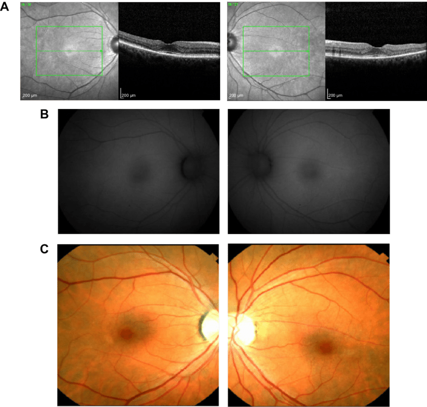 Bull's Eye Maculopathy Visible On Near-infrared Reflectance - Medical Imaging (850x810), Png Download