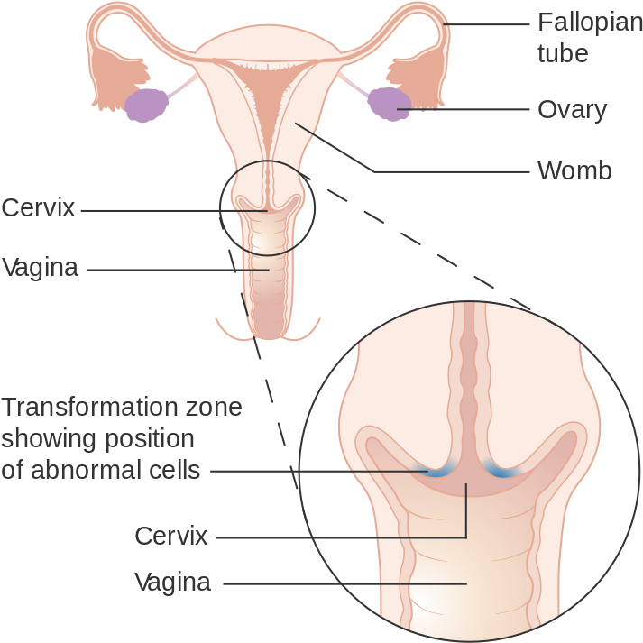 Cervical Cancer - Cervix Anatomy Transitional Zone (768x768), Png Download