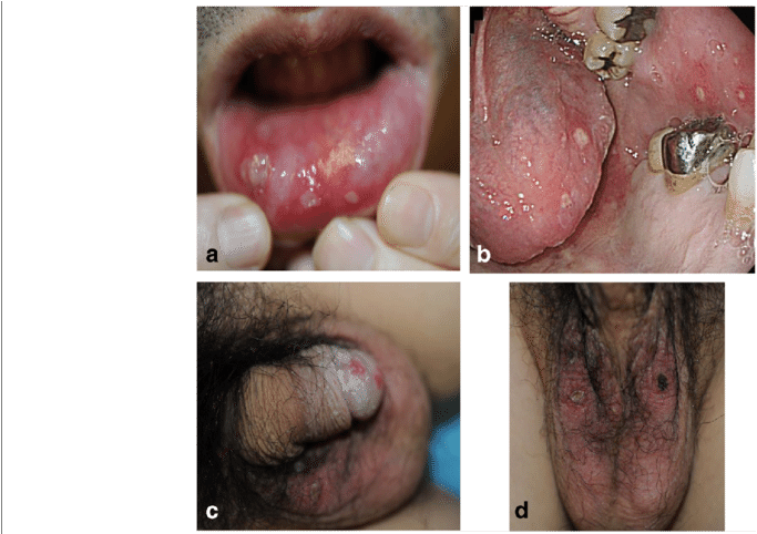 A Ulcers On The Lower Lip - Tongue (850x481), Png Download