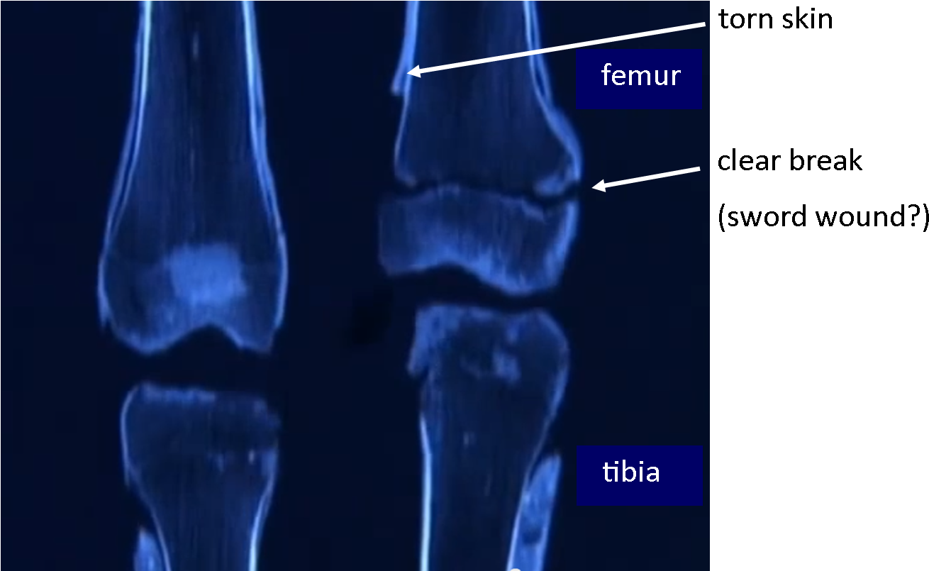 Tut's Leg Bones - King Tut Broken Femur (1411x816), Png Download
