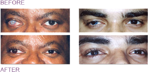 Corneal Tattoos - Tattoo (620x334), Png Download