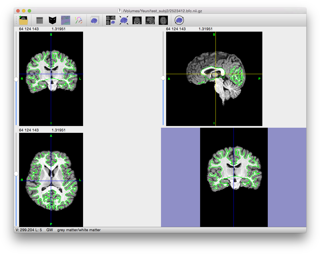 Click On The Image To The Right For A Larger View - B1 Bias Field Correction (1136x902), Png Download