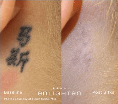 Tattoo Removal* - Tattoo (1060x440), Png Download