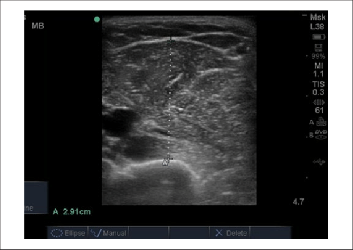 Ultrasound Image Of Mid Upper Arm Muscle Thickness - Muscles Upper Arm Ultrasound (711x503), Png Download