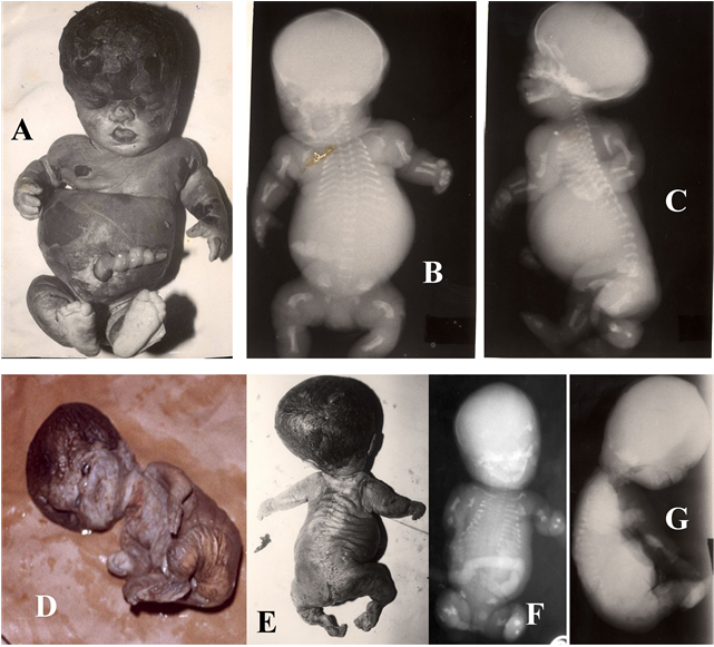 (r) Showing Lethal Skeletal Dysplasia - Byron Baxter Osteogenesis Imperfecta (902x580), Png Download