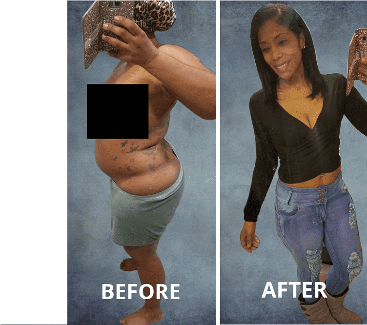 Beyond The Benefits Of Losing Weight, Orbera™ Is A - Temporary Gastric Balloon Before And After (900x665), Png Download