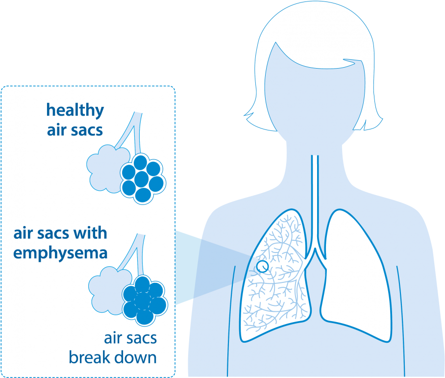 Diagram Of Lungs With Emphysema - Lung Volume Reduction Surgery Coils (1200x848), Png Download