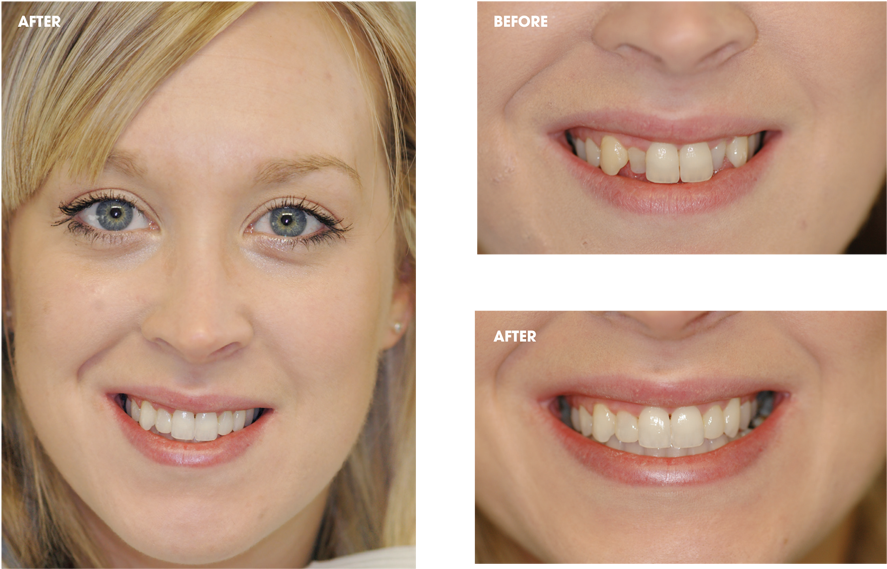 Freeuse Cfast Clear Braces Bucktown Dental Associates - C Fast Adult Braces (900x584), Png Download