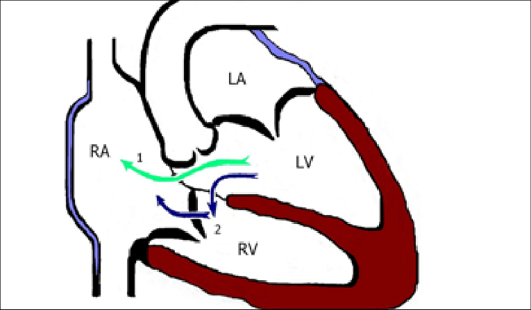 Defect Number One Is The Supravalvular (direct) Type, (765x447), Png Download