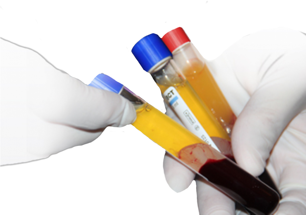 What Part Of The Face Can Prp Treat - Blood Plasma (1000x819), Png Download