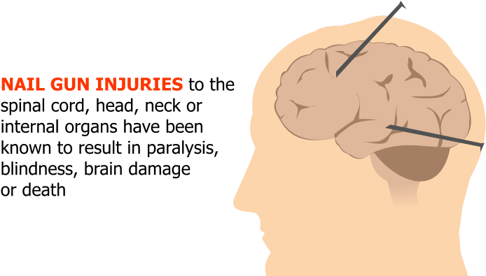 Nail Gun Injuries To The Spinal Cord, Head, Neck Or - Injury (757x394), Png Download