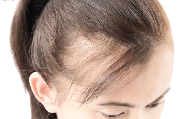 Hair Rescue Treatment Program For Men And Women - Hair Loss On Sides Female (870x504), Png Download