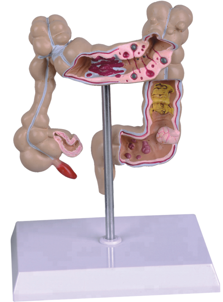 Human Diseased Large Intestines Model For Education - Child Carousel (1000x999), Png Download