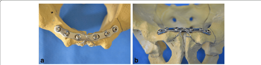 Tension Band Wiring Technique Over The Plate - Tension Band Plate Pelvis (850x213), Png Download