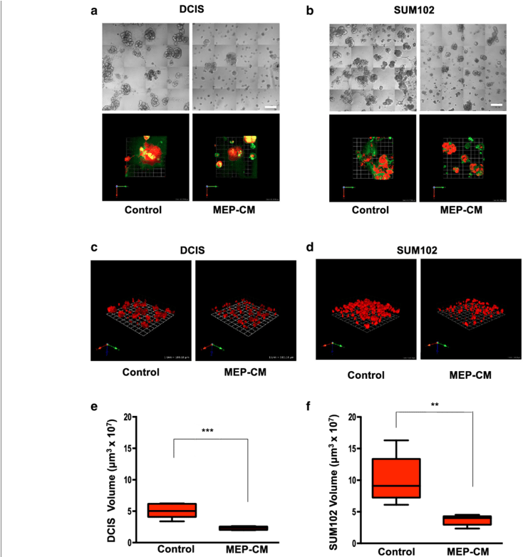 Formed In Mammary Architecture And Microenvironment - Ductal Carcinoma In Situ (850x781), Png Download