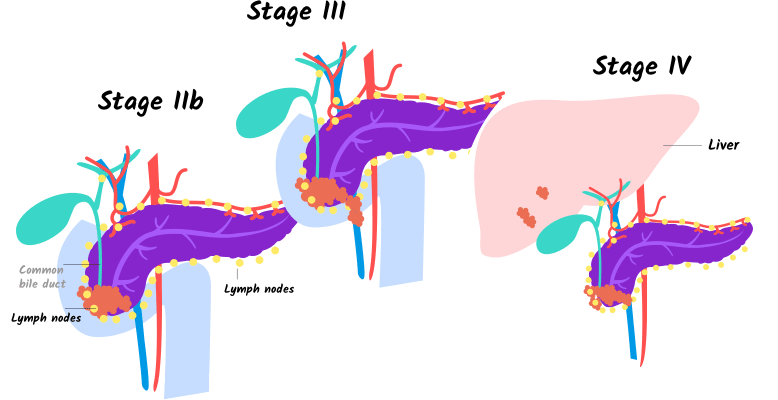 Illustration Of Stages Iib, Iii, And Iv Of Pancreatic - Does Stage 4 Pancreatic Cancer Look (778x400), Png Download