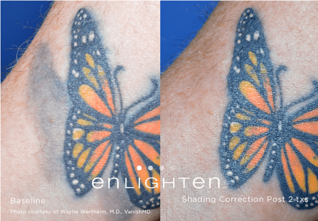 Tattoo Removal* - Tattoo (1060x440), Png Download