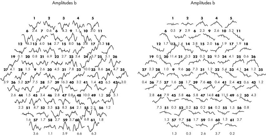 Preoperative Multifocal Electroretinogram Of Case 1 - Handwriting (850x435), Png Download
