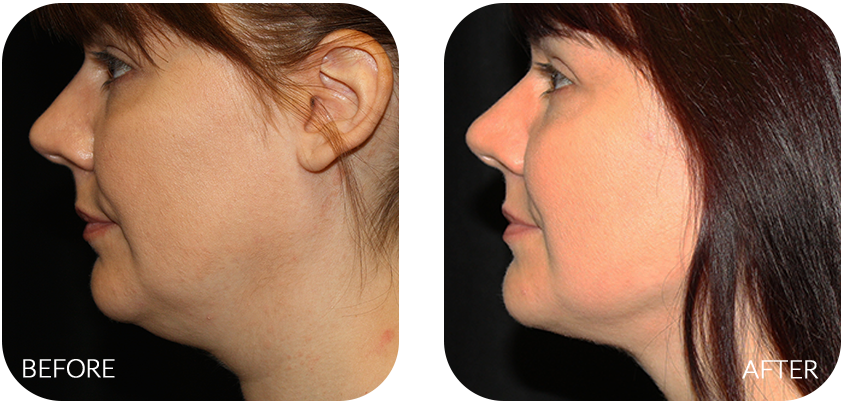 While Diet And Exercise Are Effective In Combating - Chin Filler And Liposuction (842x404), Png Download