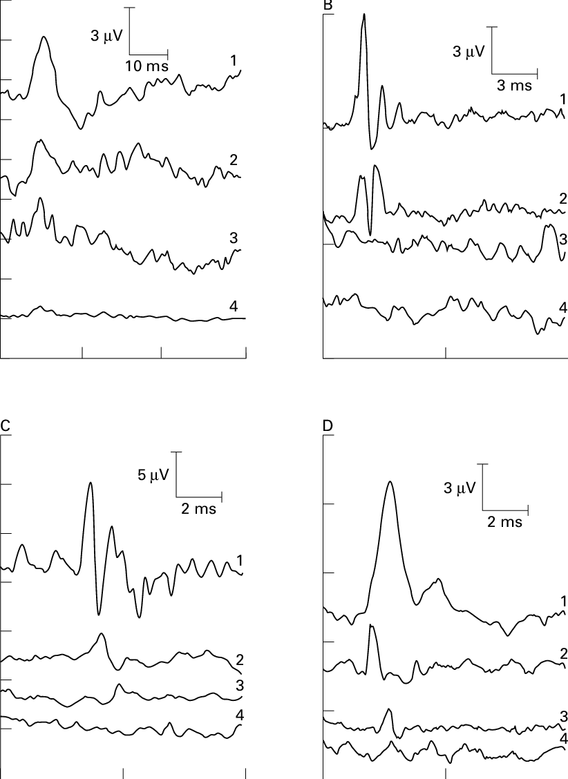 Sample Of Various Ep Waveforms Under Diverent Spinal - Diagram (822x1128), Png Download