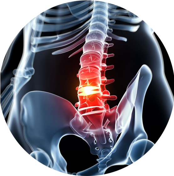 When The Spine Begins To Narrow Putting Pressure On - Imagini Hernie De Disc (586x611), Png Download