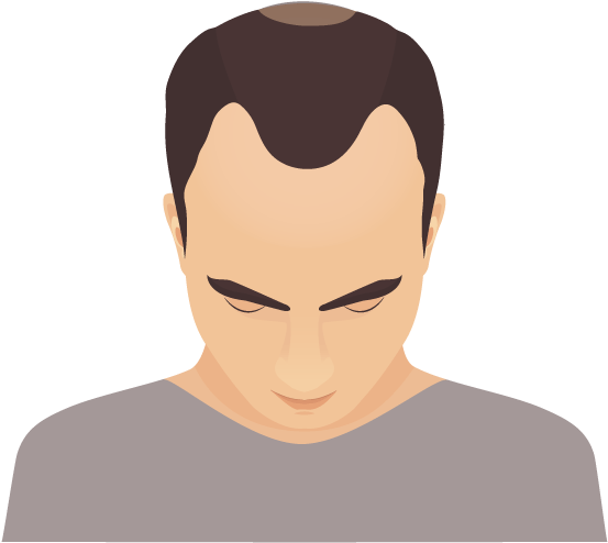 In Phase 2 Of Male Pattern Baldness We Start To Notice - Illustration (668x606), Png Download