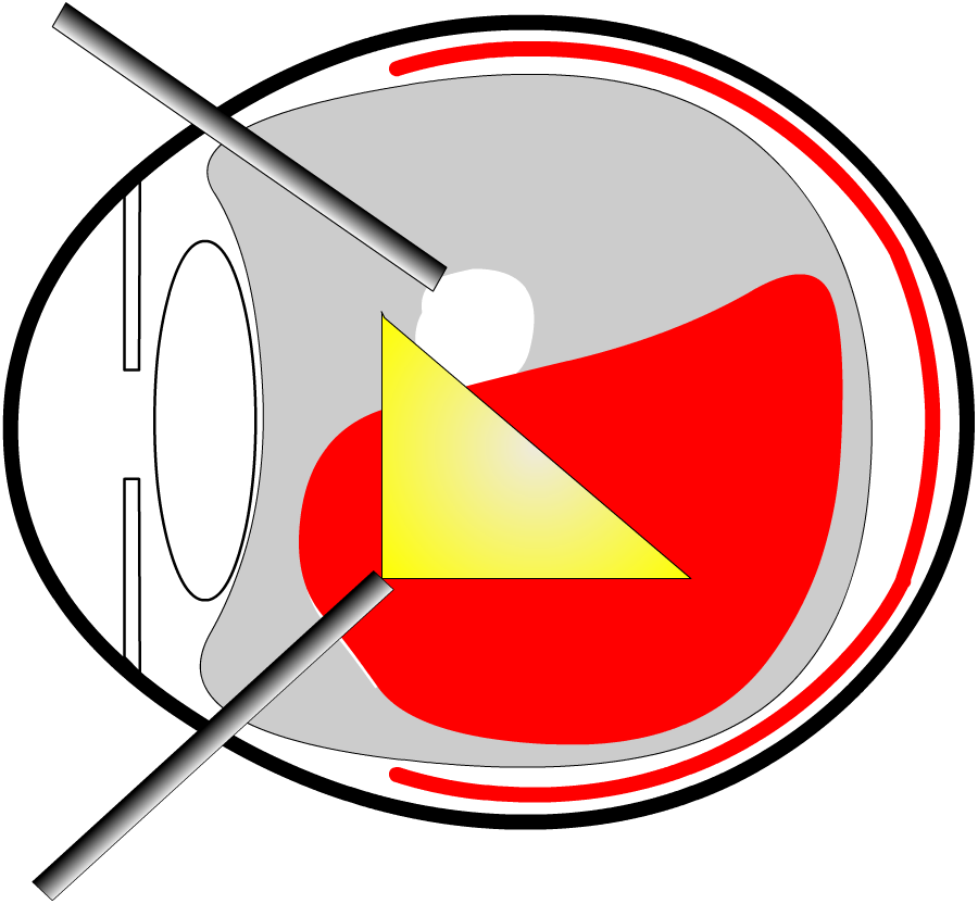 Enlarge Vitrectomy Surgery - Circle (900x832), Png Download