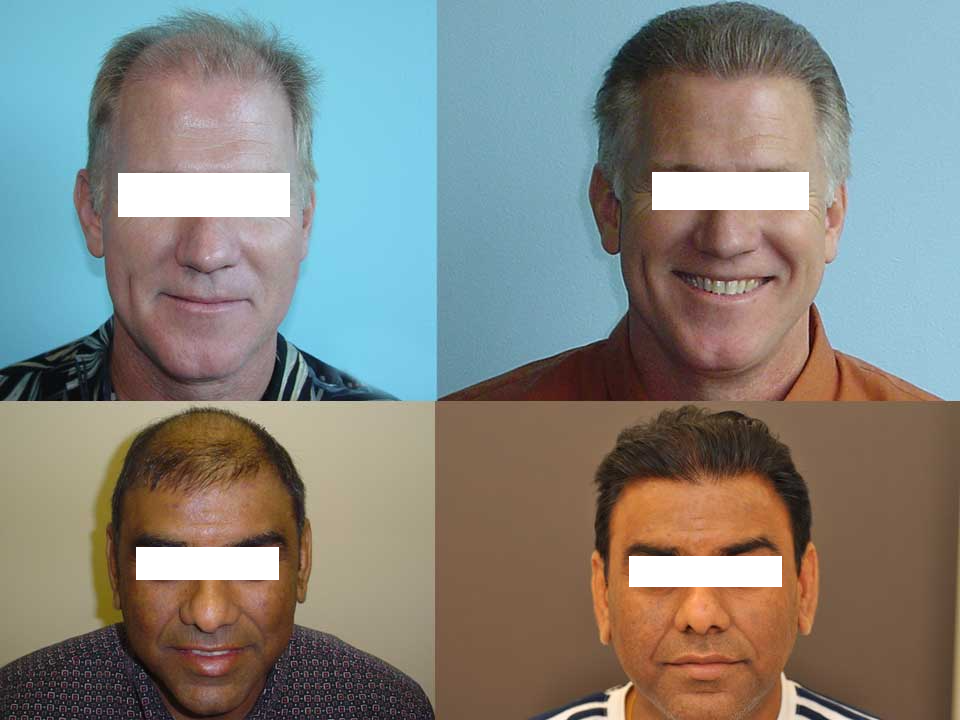 Hair Replacement Nagpur - Gentleman (960x720), Png Download