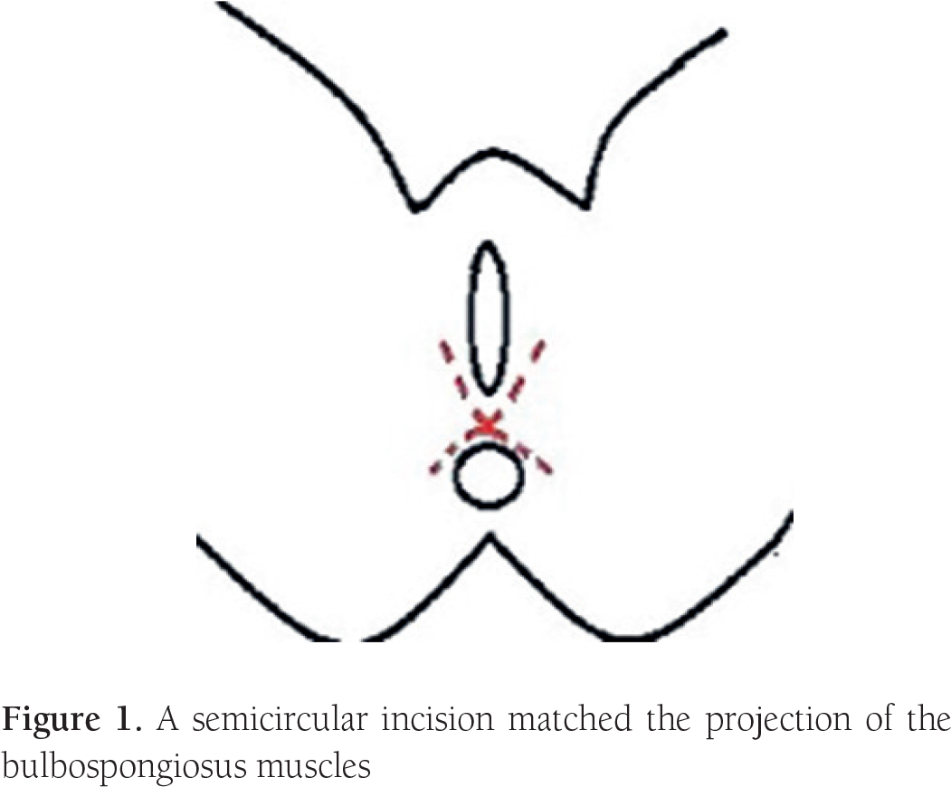 The Vaginal Mucosa Was Dissected To A Depth Of 6 Cm, - Circle (1082x898), Png Download