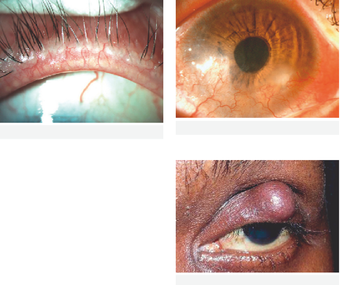 Ocular Surface Disease - Close-up (1093x917), Png Download