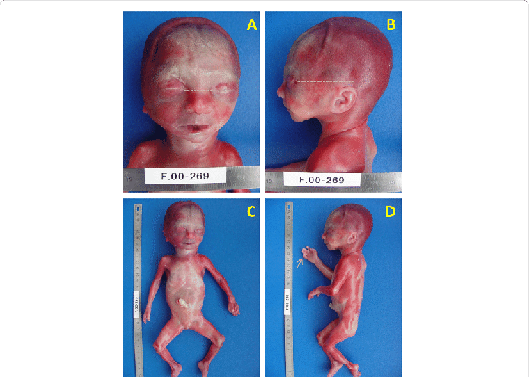 A), B) And C) Fetus Of 22 Weeks Old - Baby (760x542), Png Download
