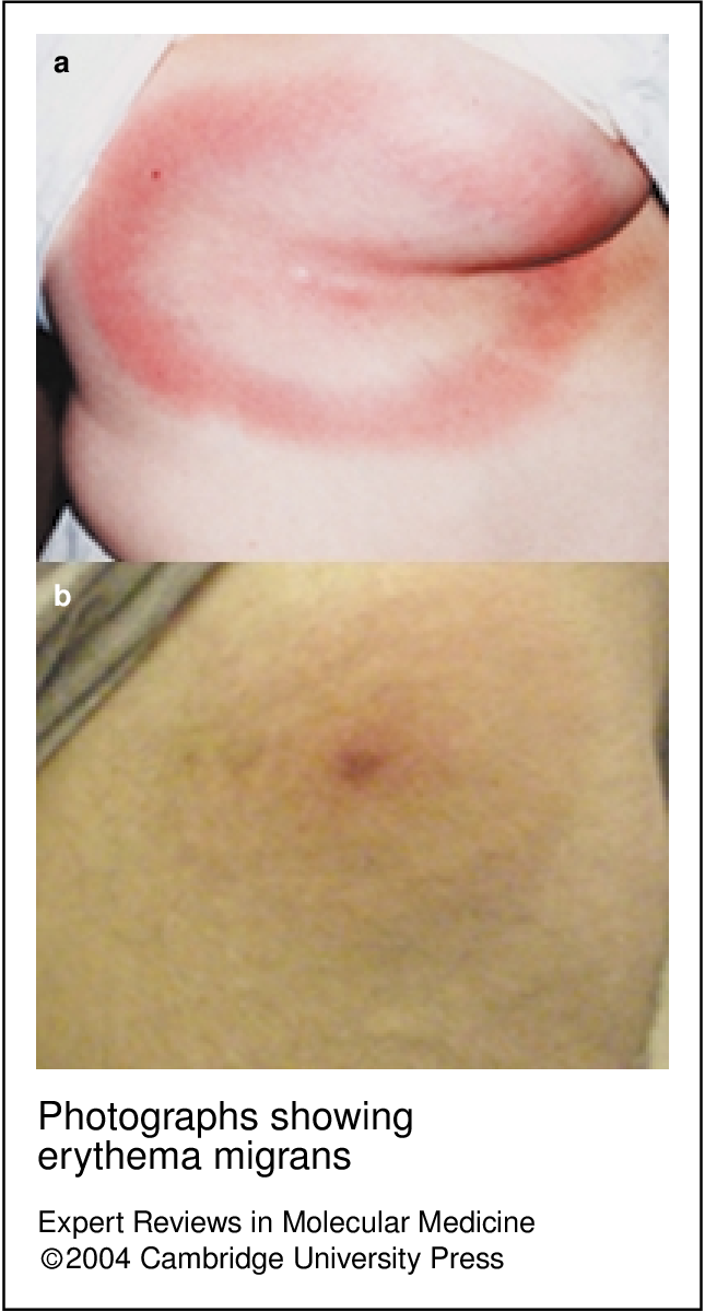 Photographs Showing Erythema Migrans - Erythema Migrans (645x1200), Png Download