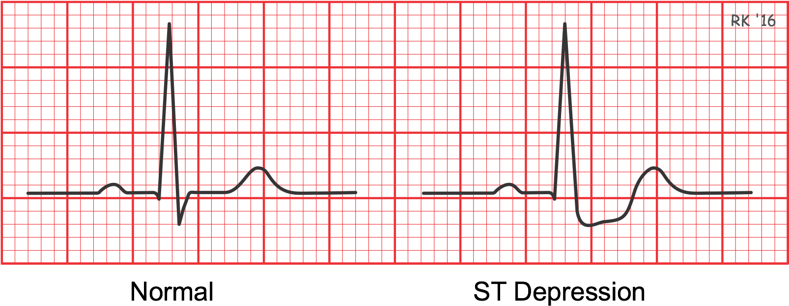 Cad012 Ecg St Depression - St Segment Depression (1629x645), Png Download