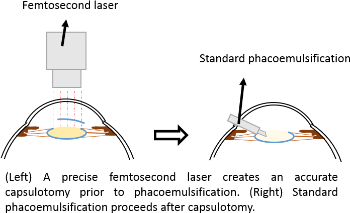 What Is Laser-assisted Cataract Surgery - Diagram (719x457), Png Download
