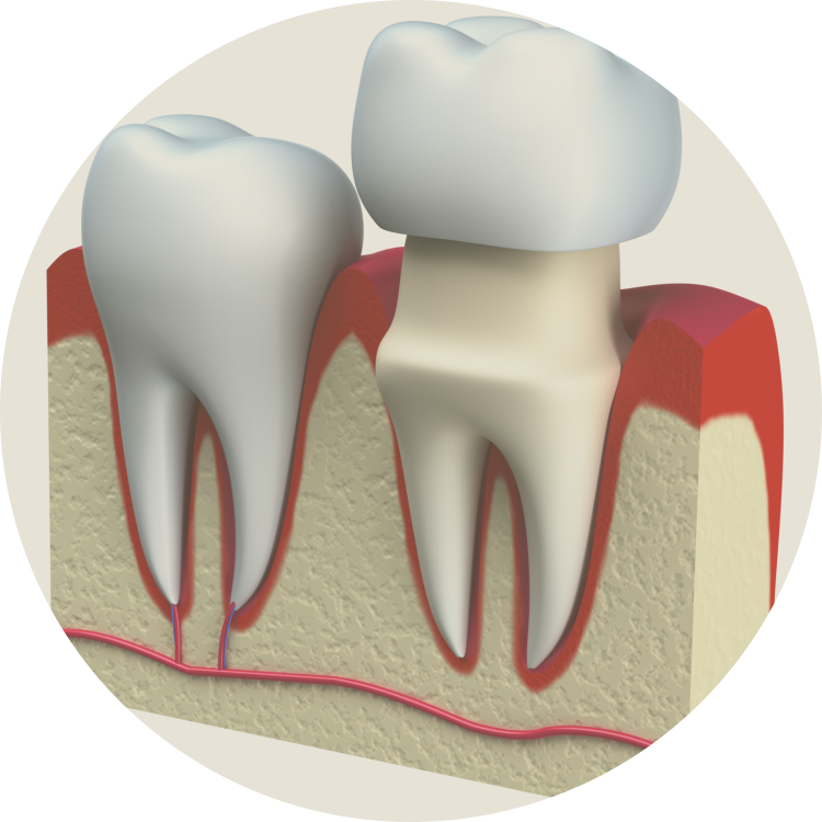 During This Time A Temporary Crown Is Worn - Tooth Porcelain Figure Png (750x750), Png Download