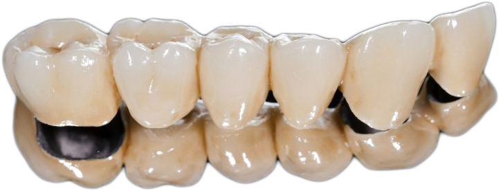 Are Crowns Made On Site Or In A Dental Laboratory All - Crowns And Bridges Fixing (721x276), Png Download